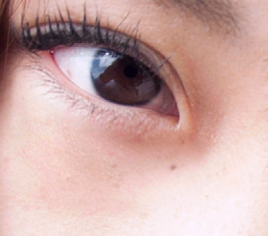 Underneath left eye healed in PS CC 2015.1 using Patch tool (Diffusion 6)